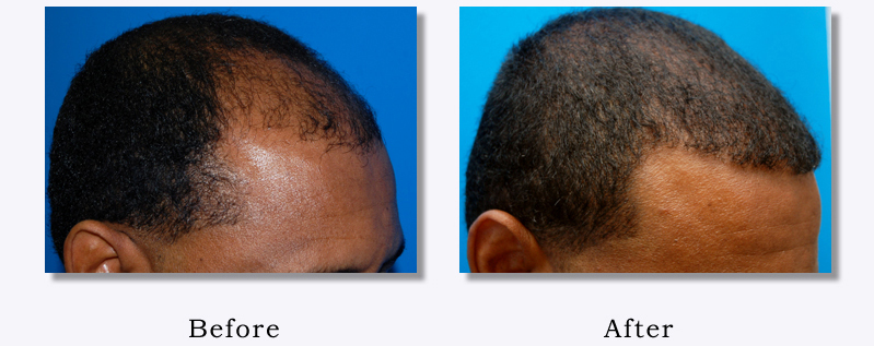Black Men & Women Hair Transplant Photos | Columbus, OH Hair Loss