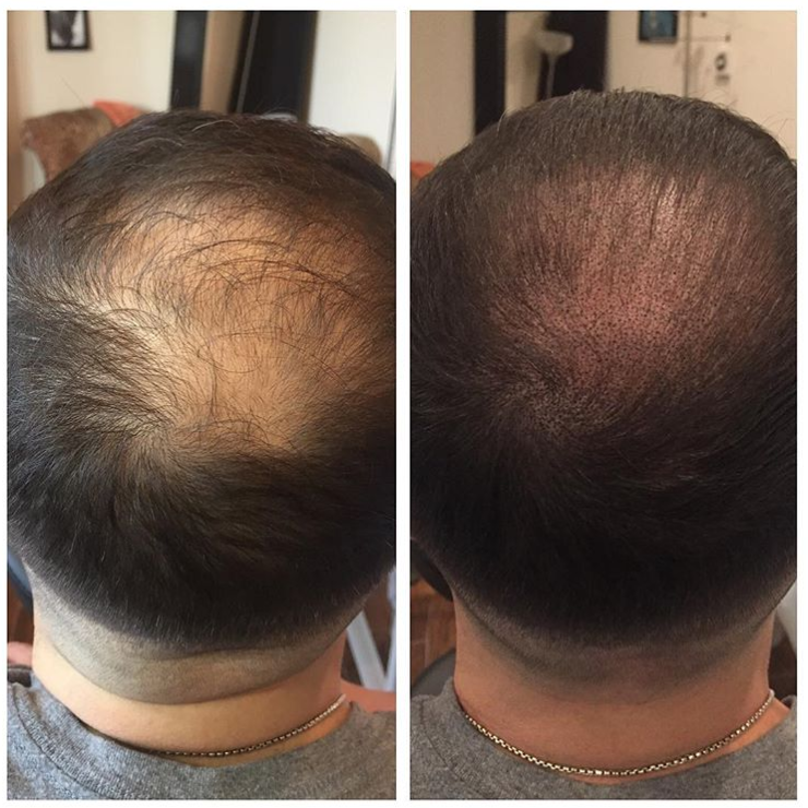 27 yr old make with pattern baldness Scalp Micro pigmentation | Hair ...