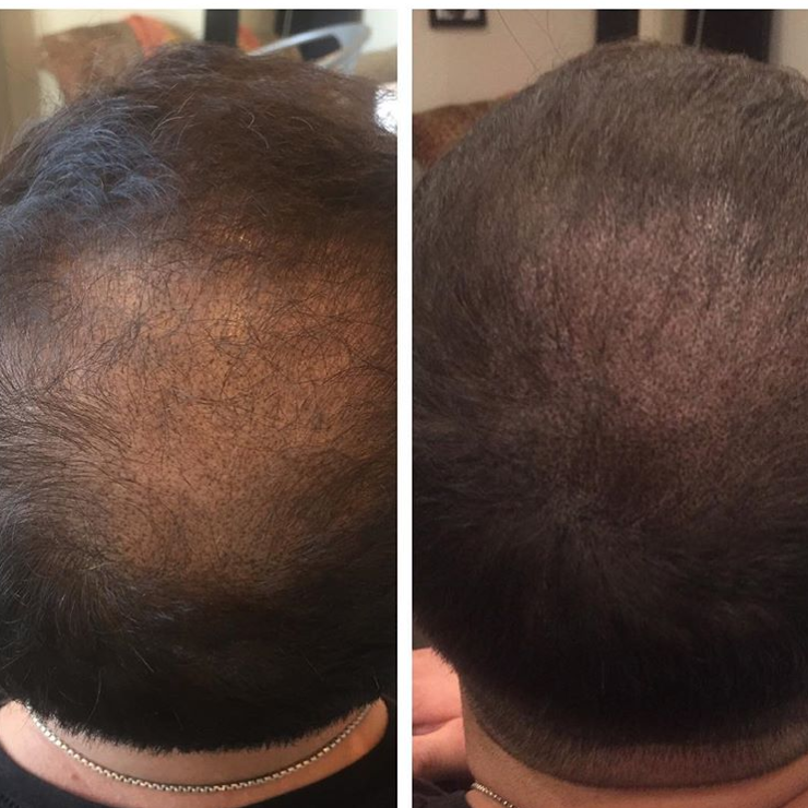 2nd density pass 27 year old male | Hair Transplant NYC & Columbus OH ...